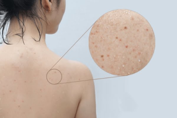 Tình trạng nổi mụn lưng