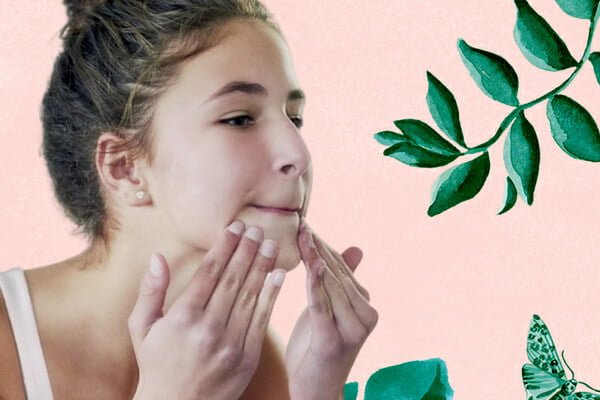 Những lưu ý khi chăm sóc da mụn ở tuổi dậy thì