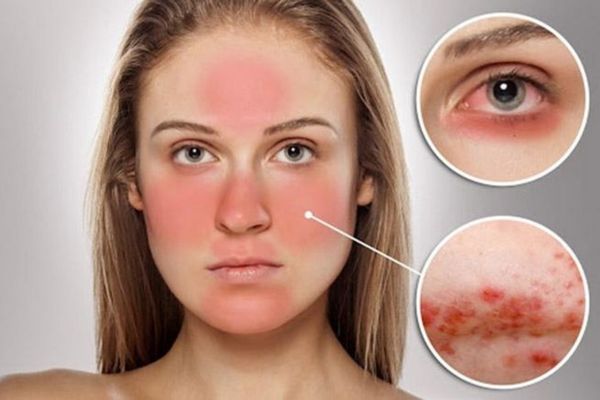 Sử dụng dược mỹ phẩm sai cách dẫn đến tình trạng mụn