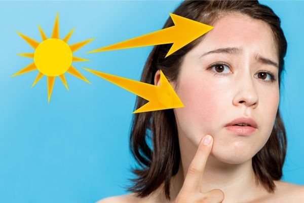 Những vấn đề da thường gặp phải vào mùa hè Những vấn đề da thường gặp phải vào mùa hè